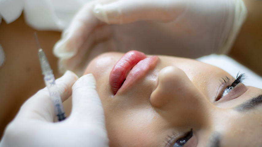The Benefits of Getting Dermal Fillers